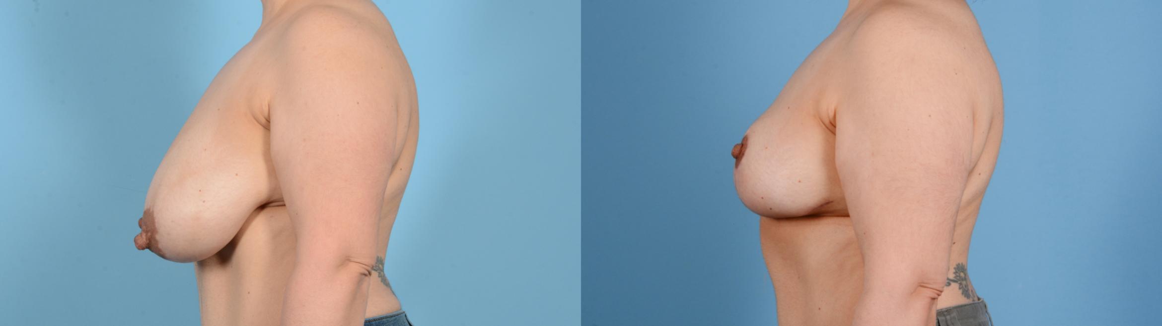 Before & After Breast Lift Case 18131 Left Side View in Houston, TX