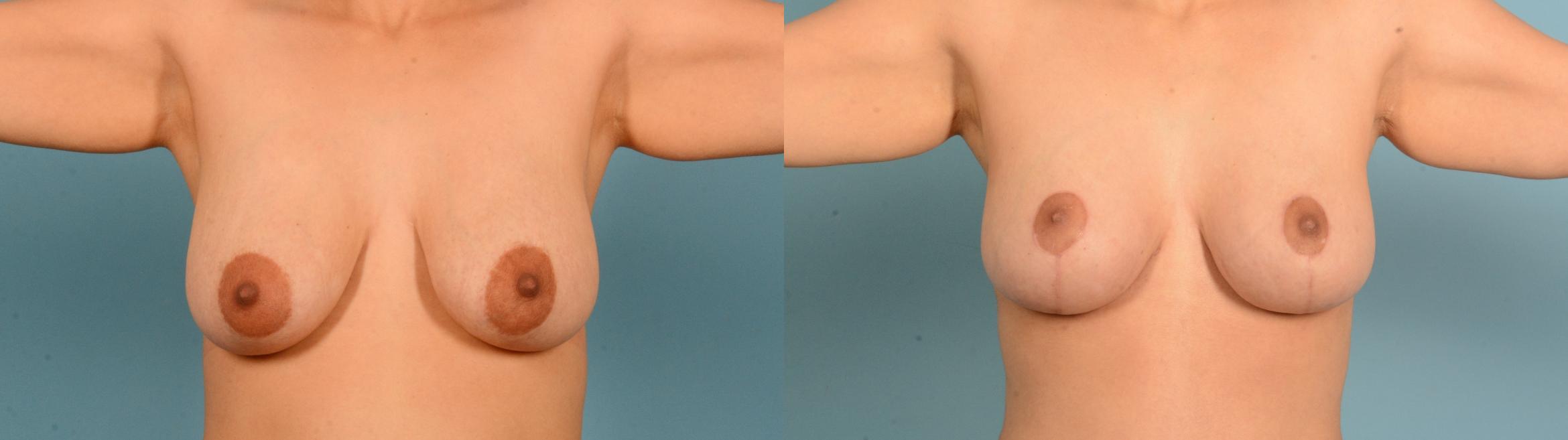 Before & After Liposuction Case 18133 Front View in Houston, TX