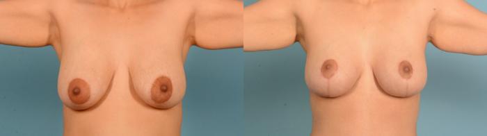 Before & After Liposuction Case 18133 Front View in Houston, TX