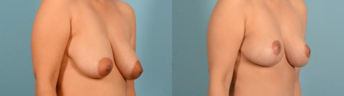 Before & After Liposuction Case 18133 Right Oblique View in Houston, TX