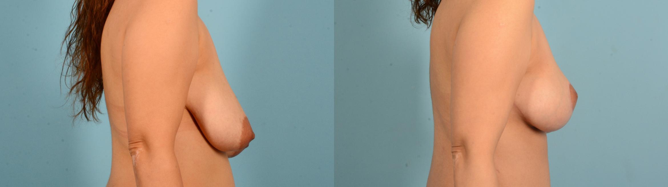 Before & After Liposuction Case 18133 Right Side View in Houston, TX