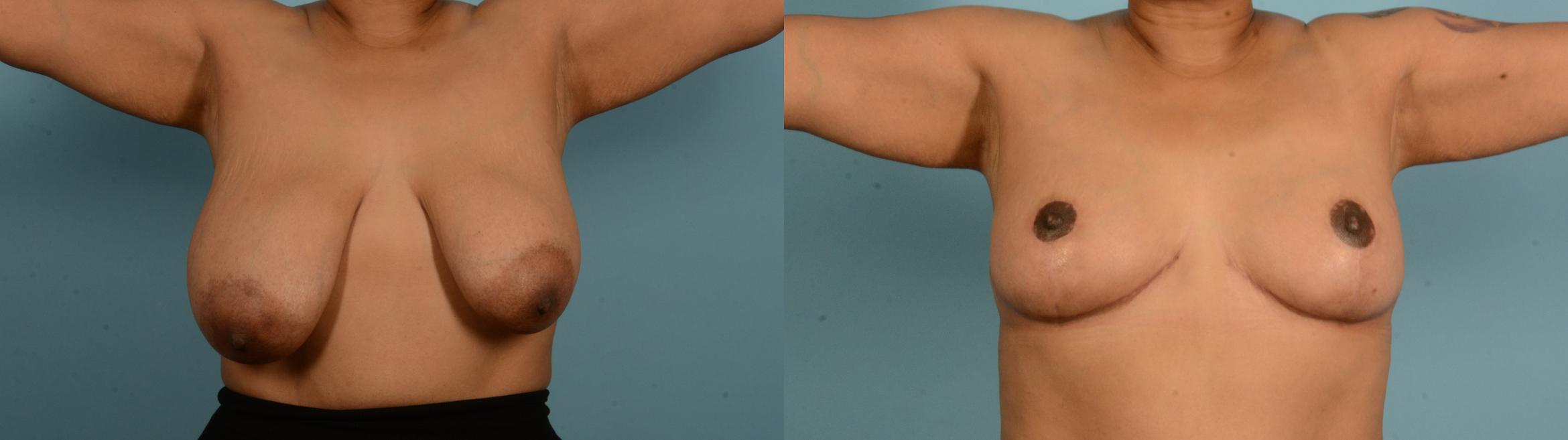 Before & After Breast Lift Case 18135 Front View in Houston, TX