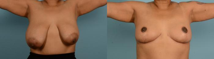 Before & After Breast Lift Case 18135 Front View in Houston, TX