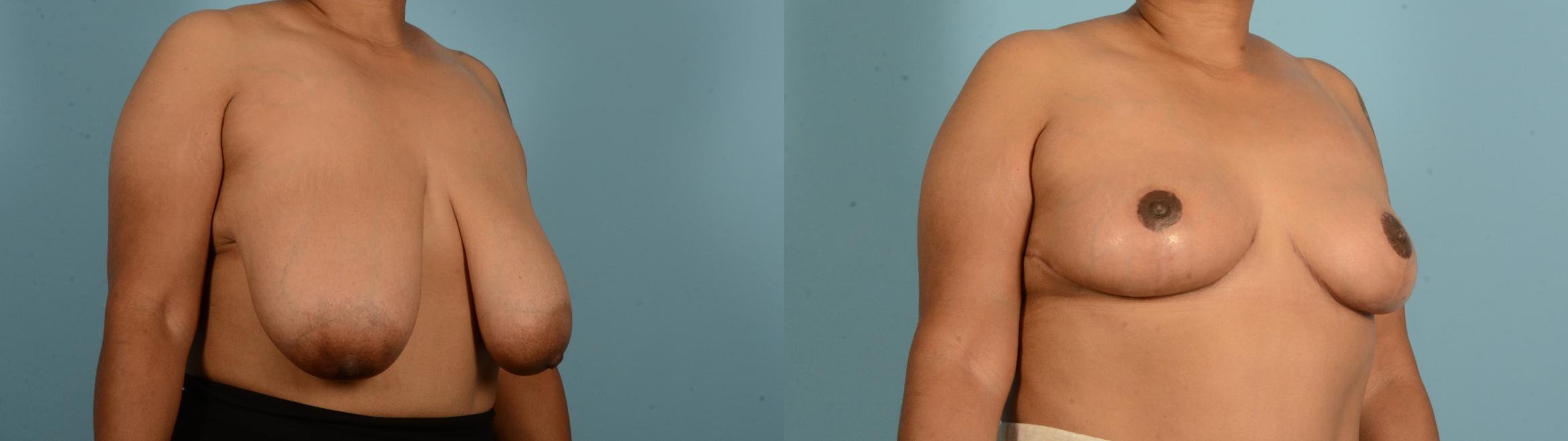 Before & After Breast Lift Case 18135 Right Oblique View in Houston, TX