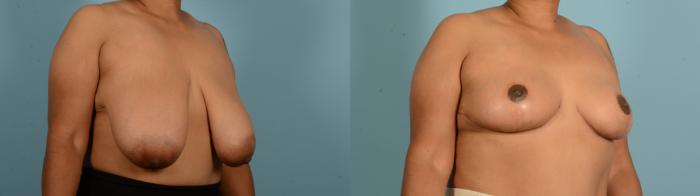 Before & After Breast Lift Case 18135 Right Oblique View in Houston, TX