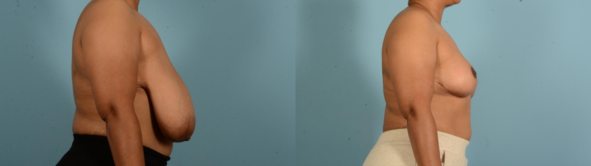 Before & After Breast Lift Case 18135 Right Side View in Houston, TX