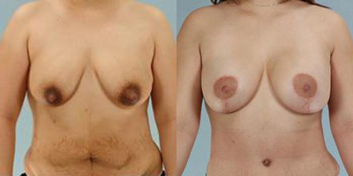 Before & After Breast Lift Case 4892 View 1 View in Houston, TX
