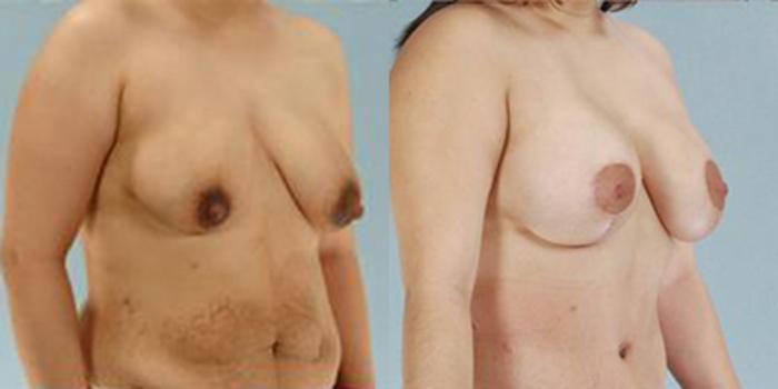 Before & After Breast Lift Case 4892 View 2 View in Houston, TX