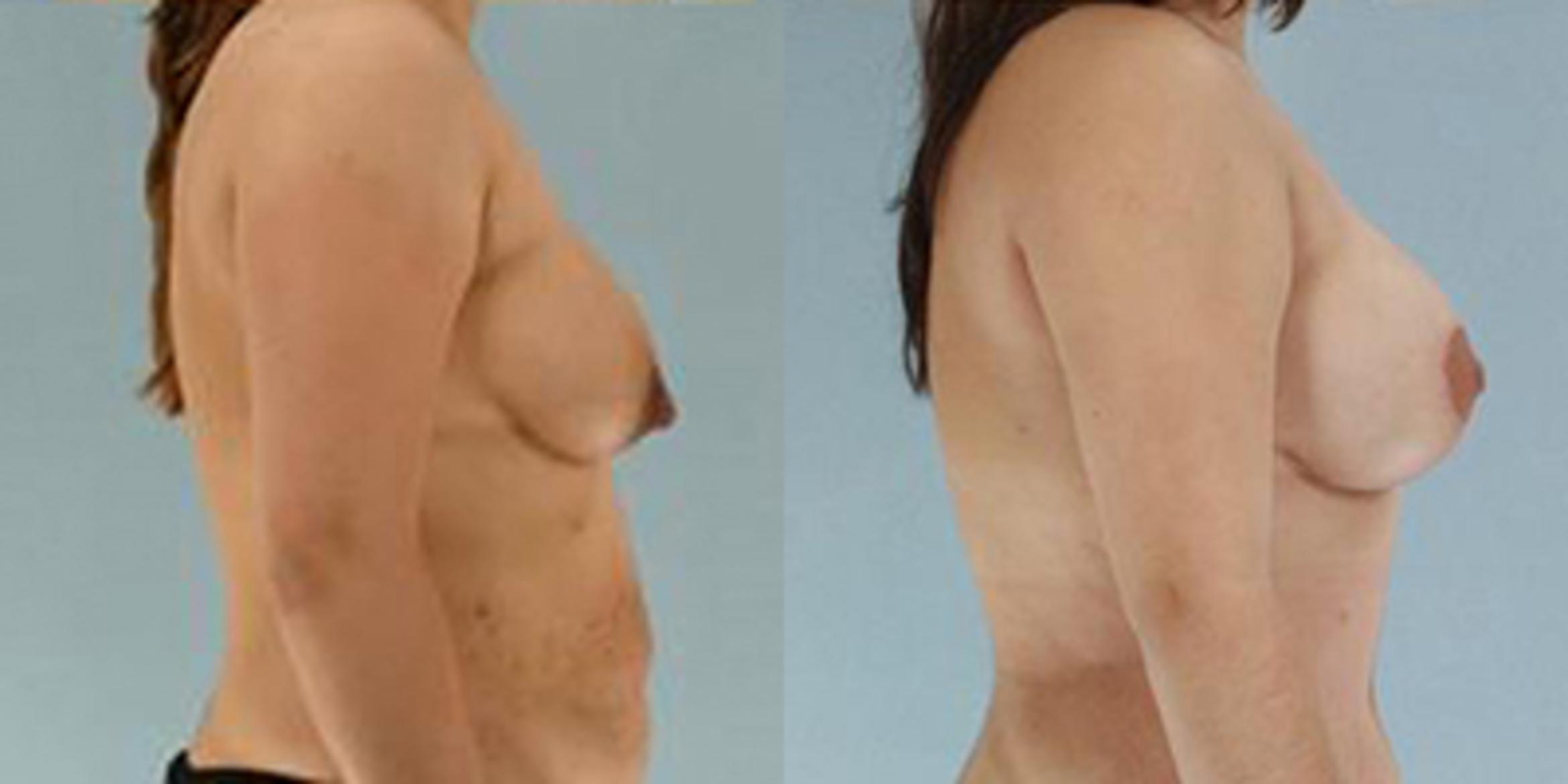 Before & After Breast Lift Case 4892 View 3 View in Houston, TX