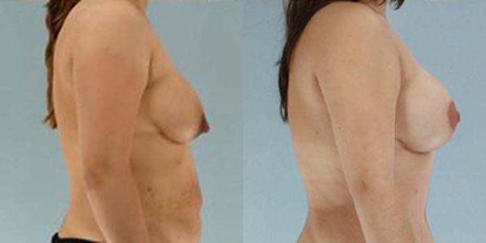 Before & After Breast Lift Case 4892 View 3 View in Houston, TX