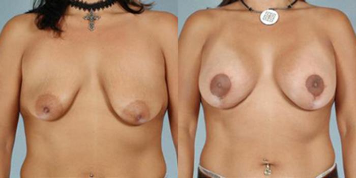 Before & After Breast Lift Case 4900 View 1 View in Houston, TX