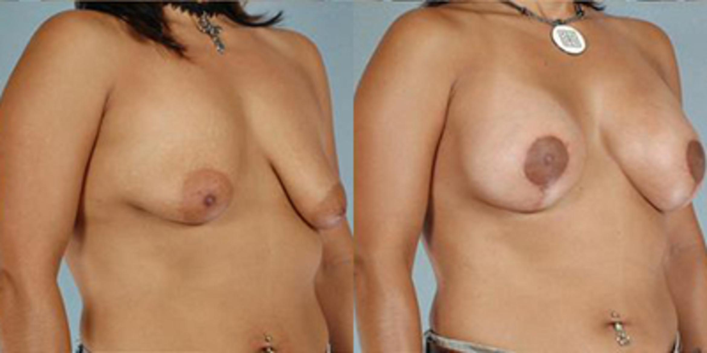 Before & After Breast Lift Case 4900 View 2 View in Houston, TX