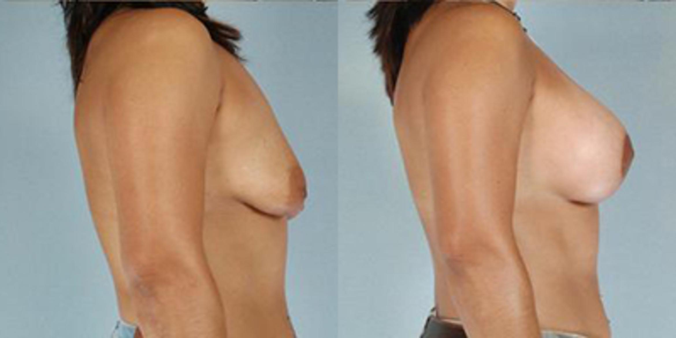 Before & After Breast Lift Case 4900 View 3 View in Houston, TX