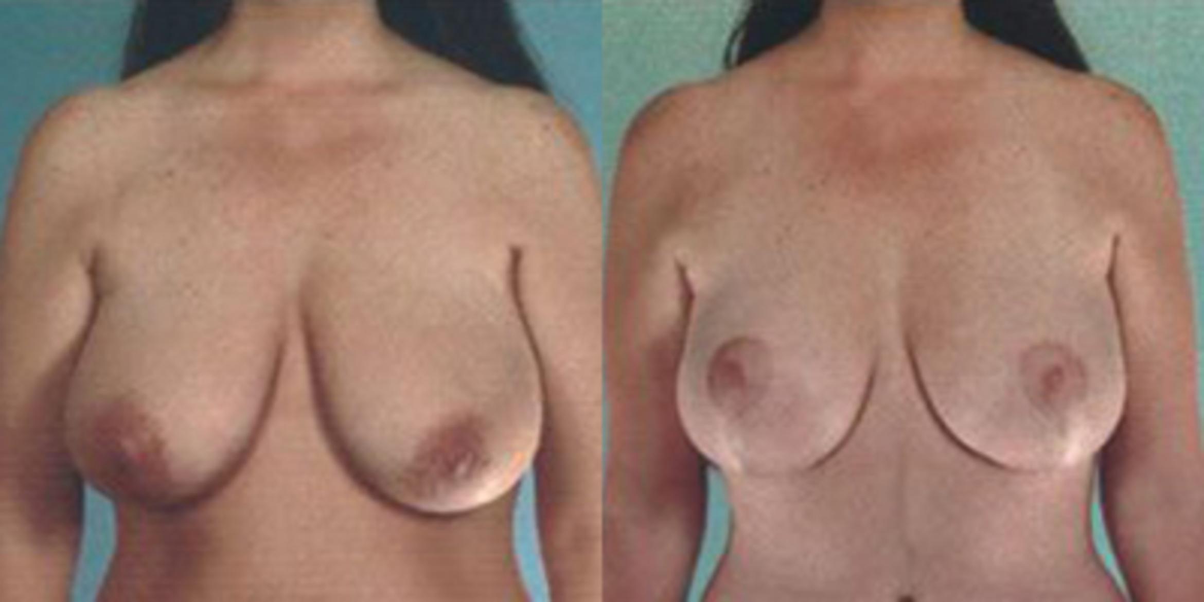 Before & After Breast Lift Case 4908 View 1 View in Houston, TX