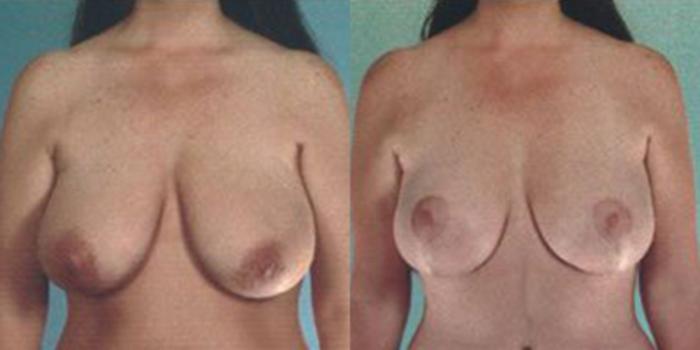 Before & After Breast Lift Case 4908 View 1 View in Houston, TX