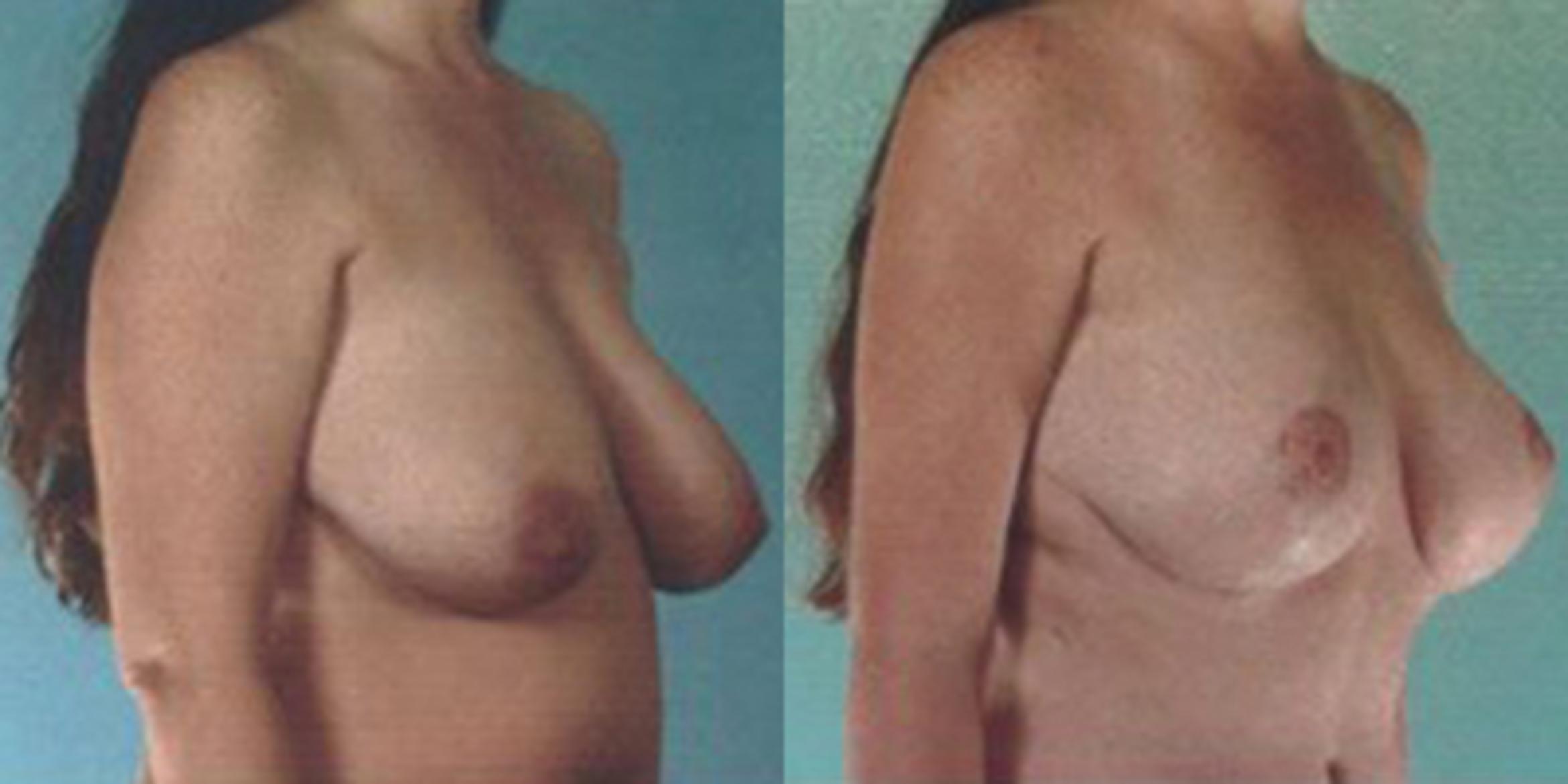 Before & After Breast Lift Case 4908 View 2 View in Houston, TX