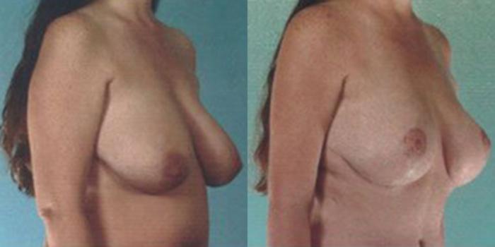 Before & After Breast Lift Case 4908 View 2 View in Houston, TX