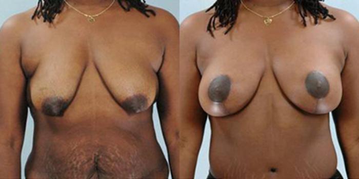 Before & After Breast Lift Case 4914 View 1 View in Houston, TX