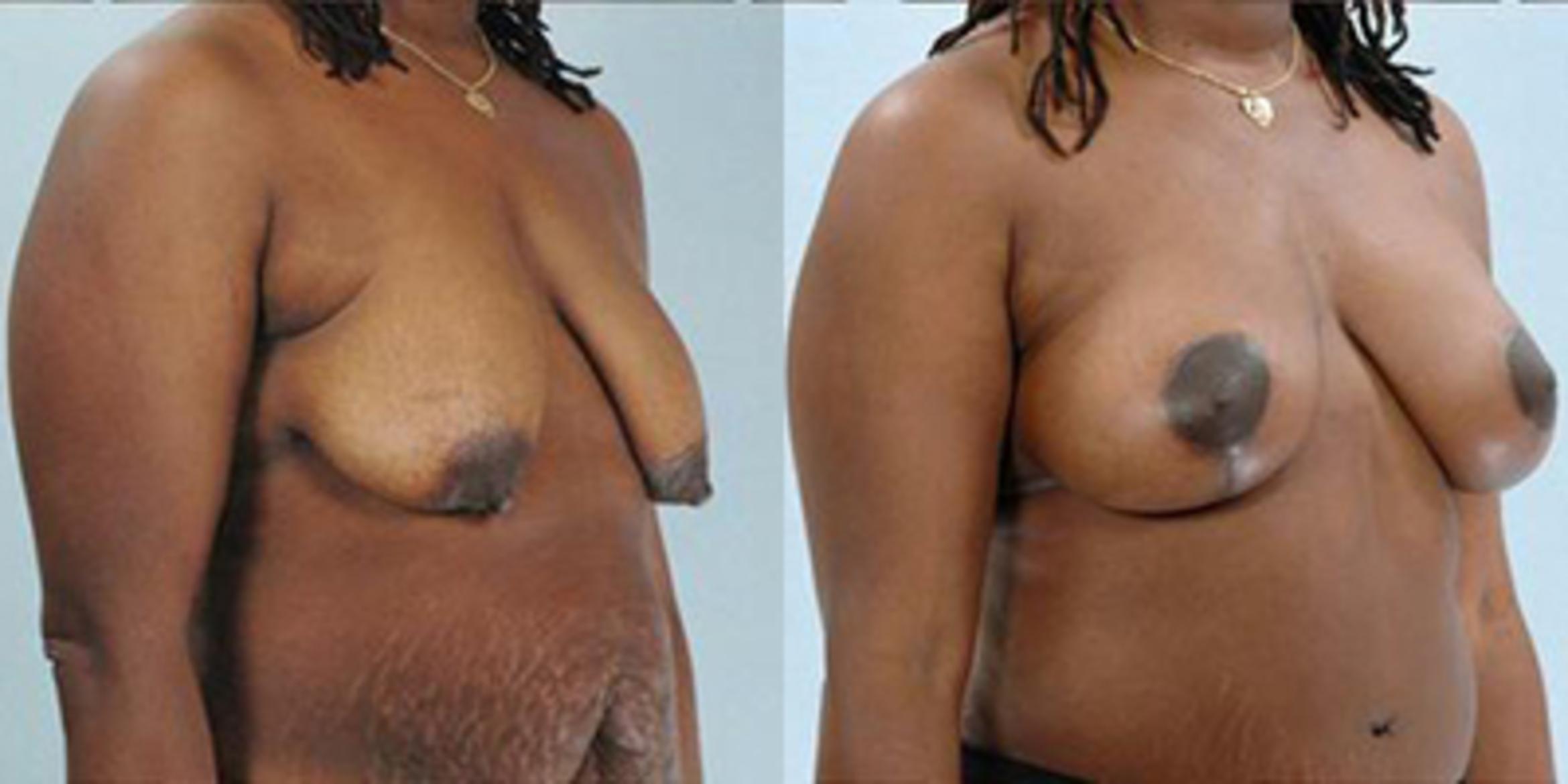 Before & After Breast Lift Case 4914 View 2 View in Houston, TX