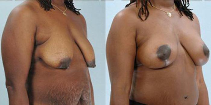 Before & After Breast Lift Case 4914 View 2 View in Houston, TX