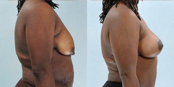Before & After Breast Lift Case 4914 View 3 View in Houston, TX