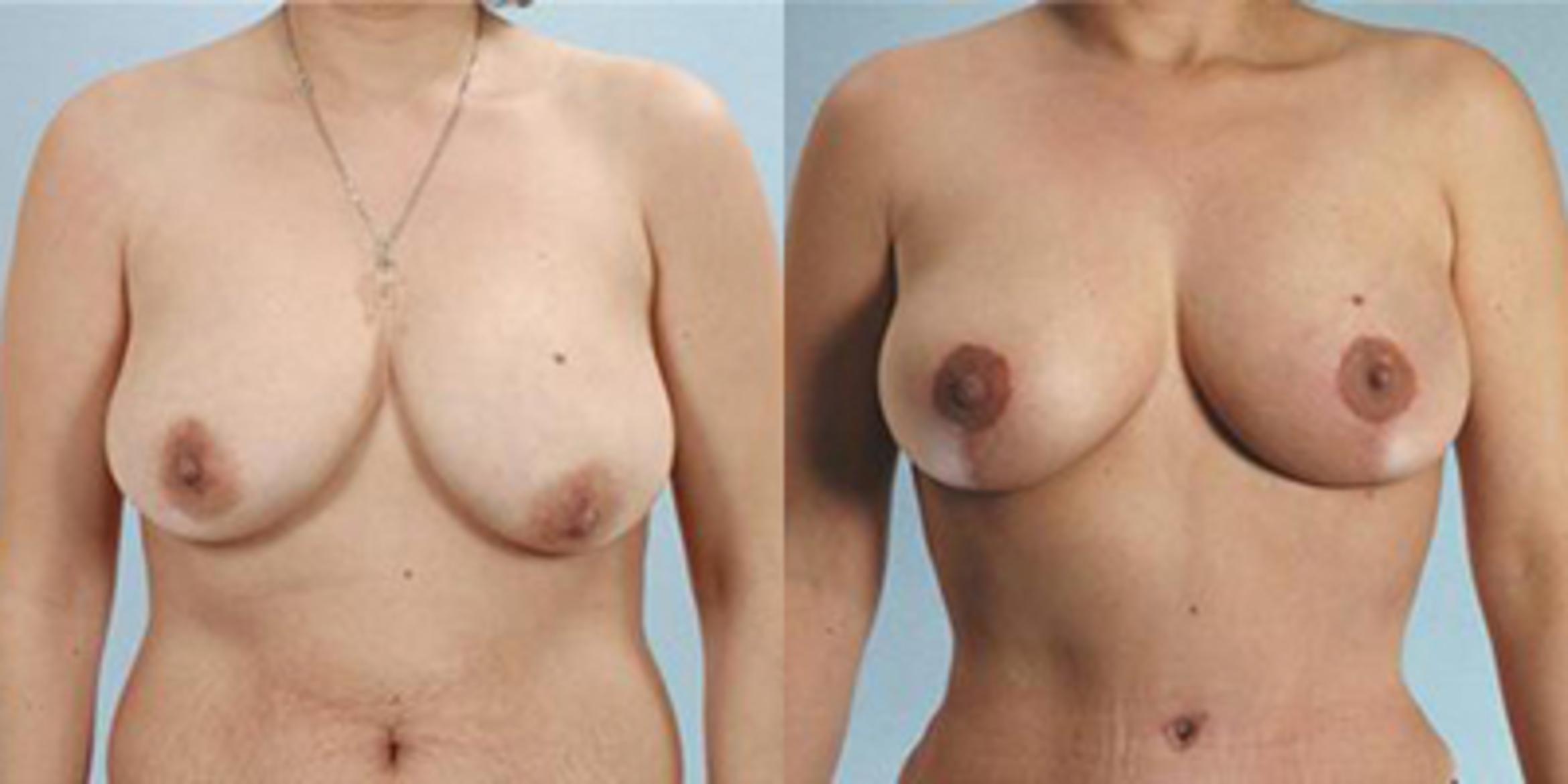 Before & After Breast Lift Case 4922 View 1 View in Houston, TX
