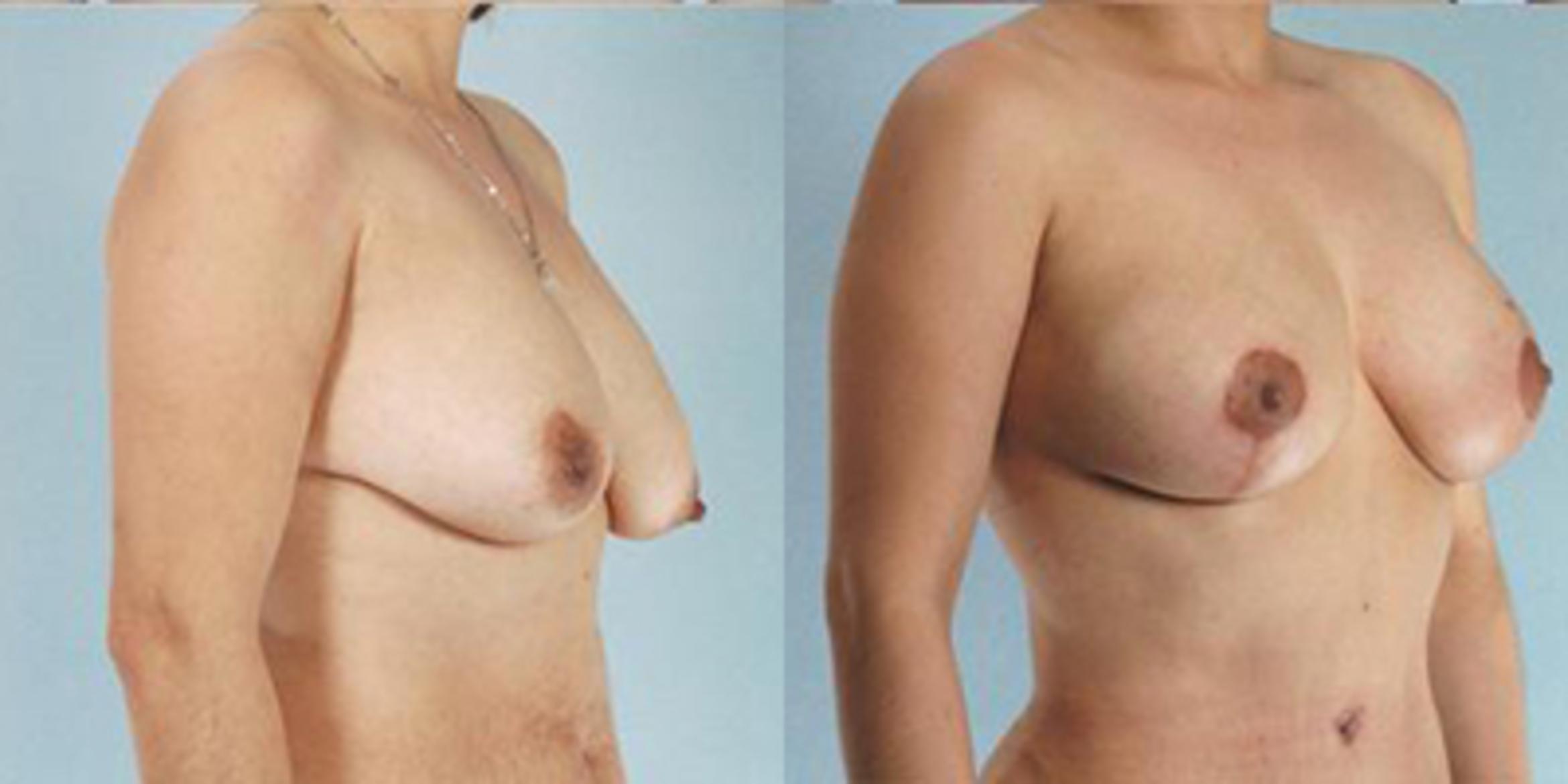 Before & After Breast Lift Case 4922 View 2 View in Houston, TX