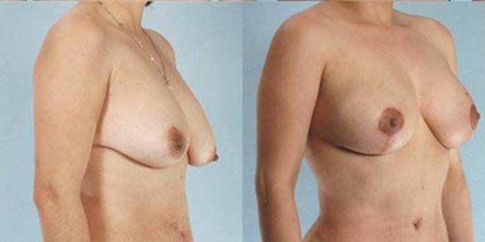 Before & After Breast Lift Case 4922 View 2 View in Houston, TX