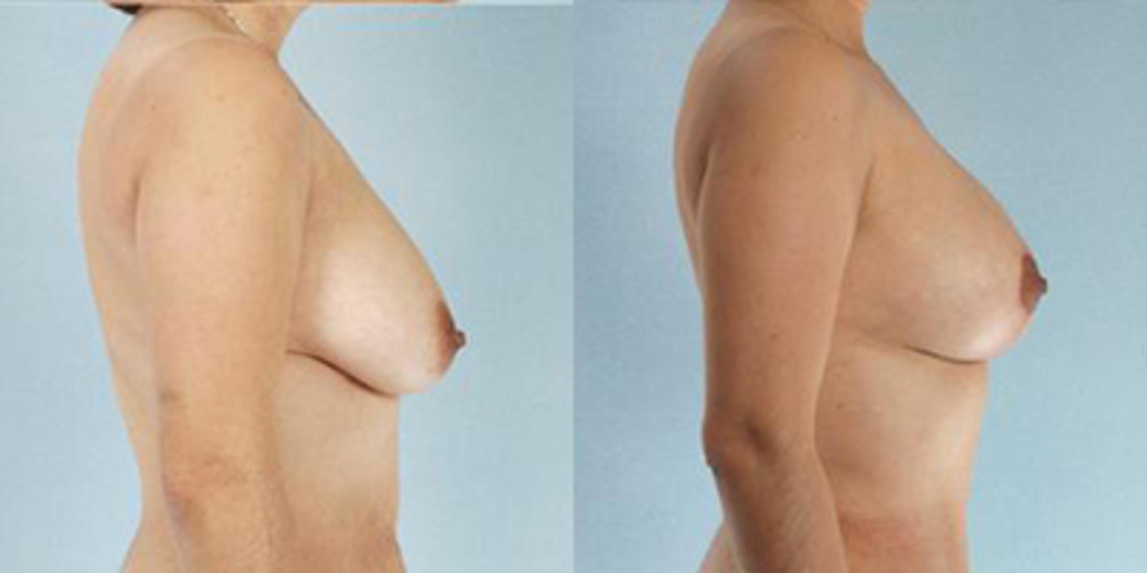 Before & After Breast Lift Case 4922 View 3 View in Houston, TX