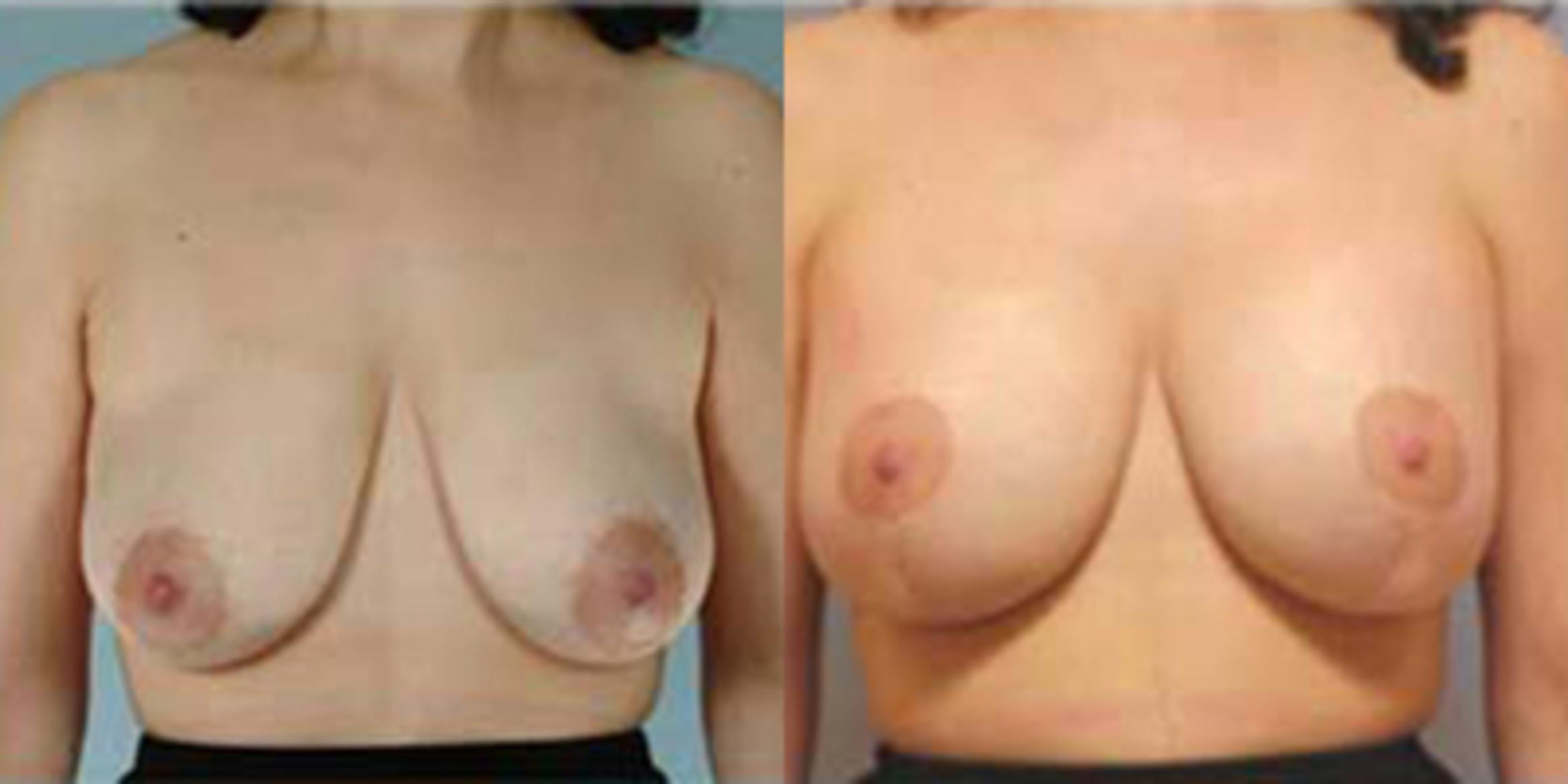 Before & After Breast Lift Case 4930 View 1 View in Houston, TX