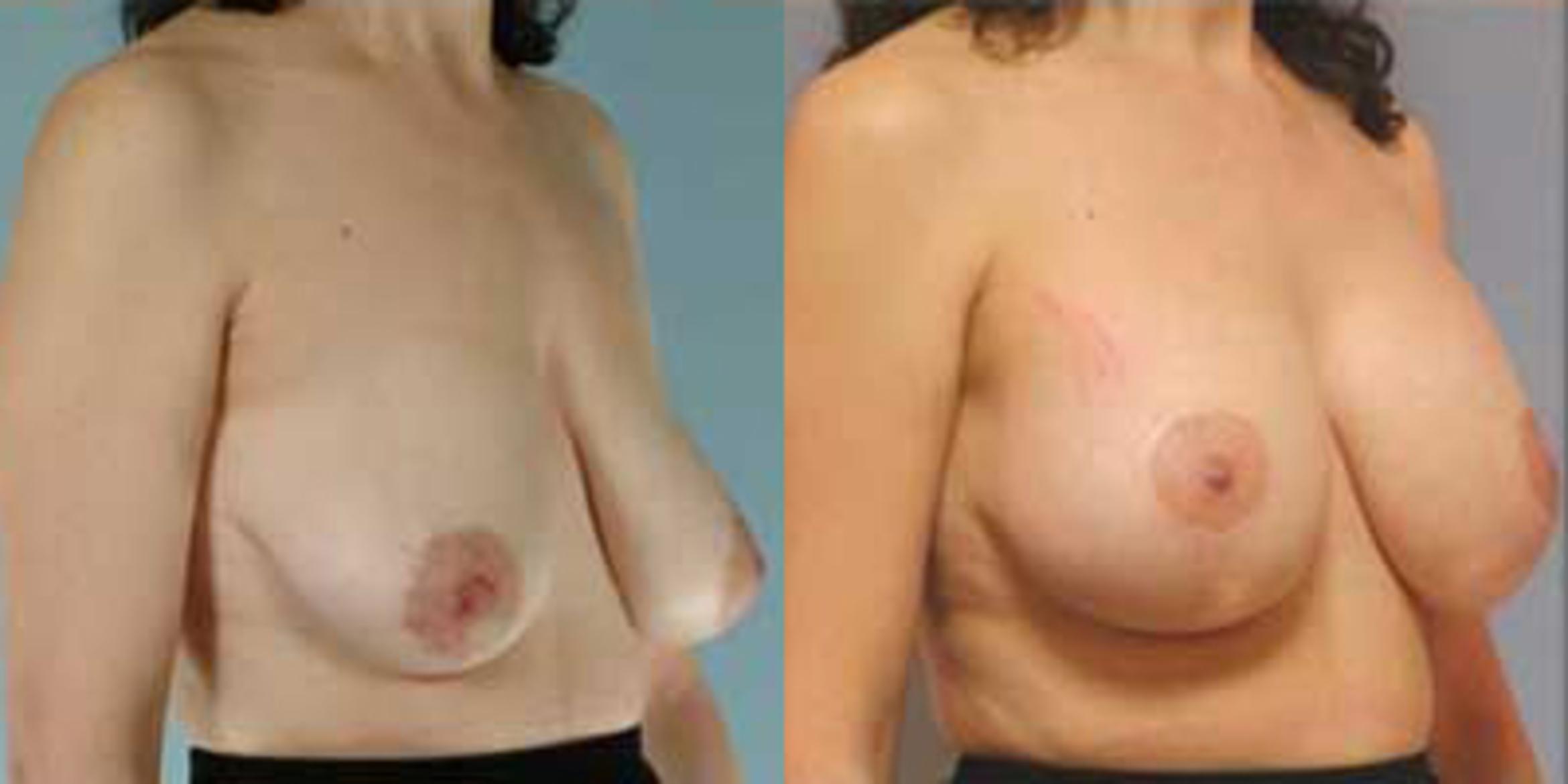 Before & After Breast Lift Case 4930 View 2 View in Houston, TX
