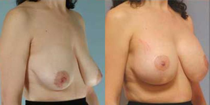 Before & After Breast Lift Case 4930 View 2 View in Houston, TX