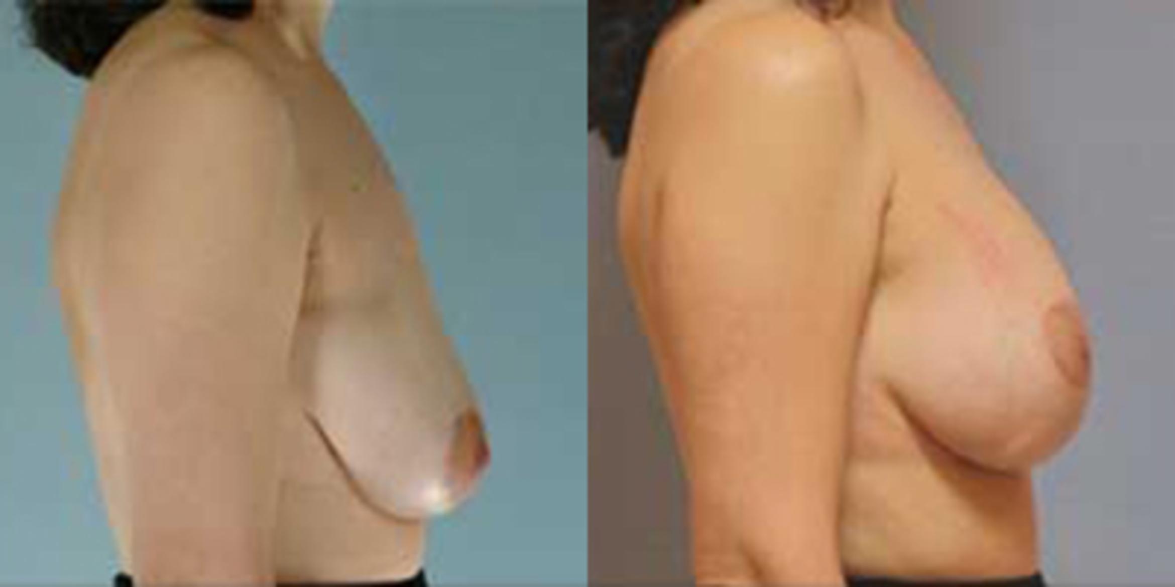Before & After Breast Lift Case 4930 View 3 View in Houston, TX