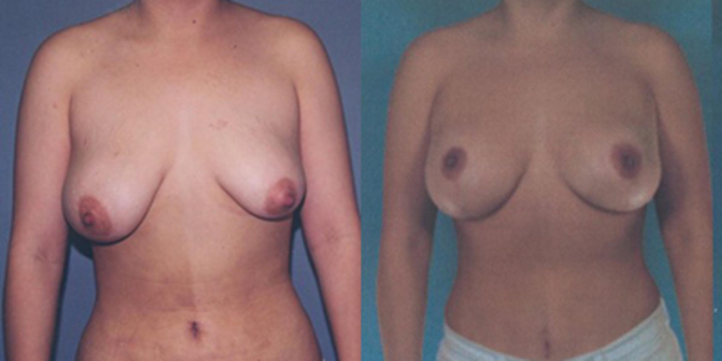 Before & After Breast Lift Case 4938 View 1 View in Houston, TX