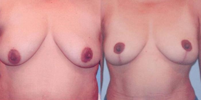Before & After Breast Lift Case 4942 View 1 View in Houston, TX