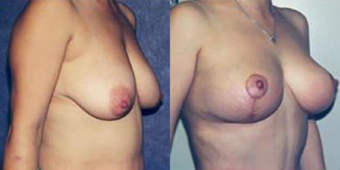 Before & After Breast Lift Case 4954 View 1 View in Houston, TX