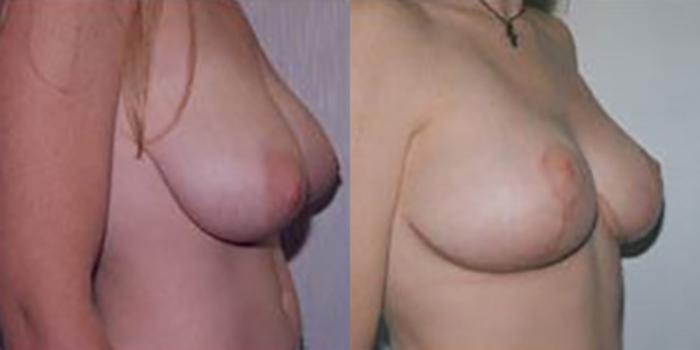Before & After Breast Lift Case 4958 View 1 View in Houston, TX