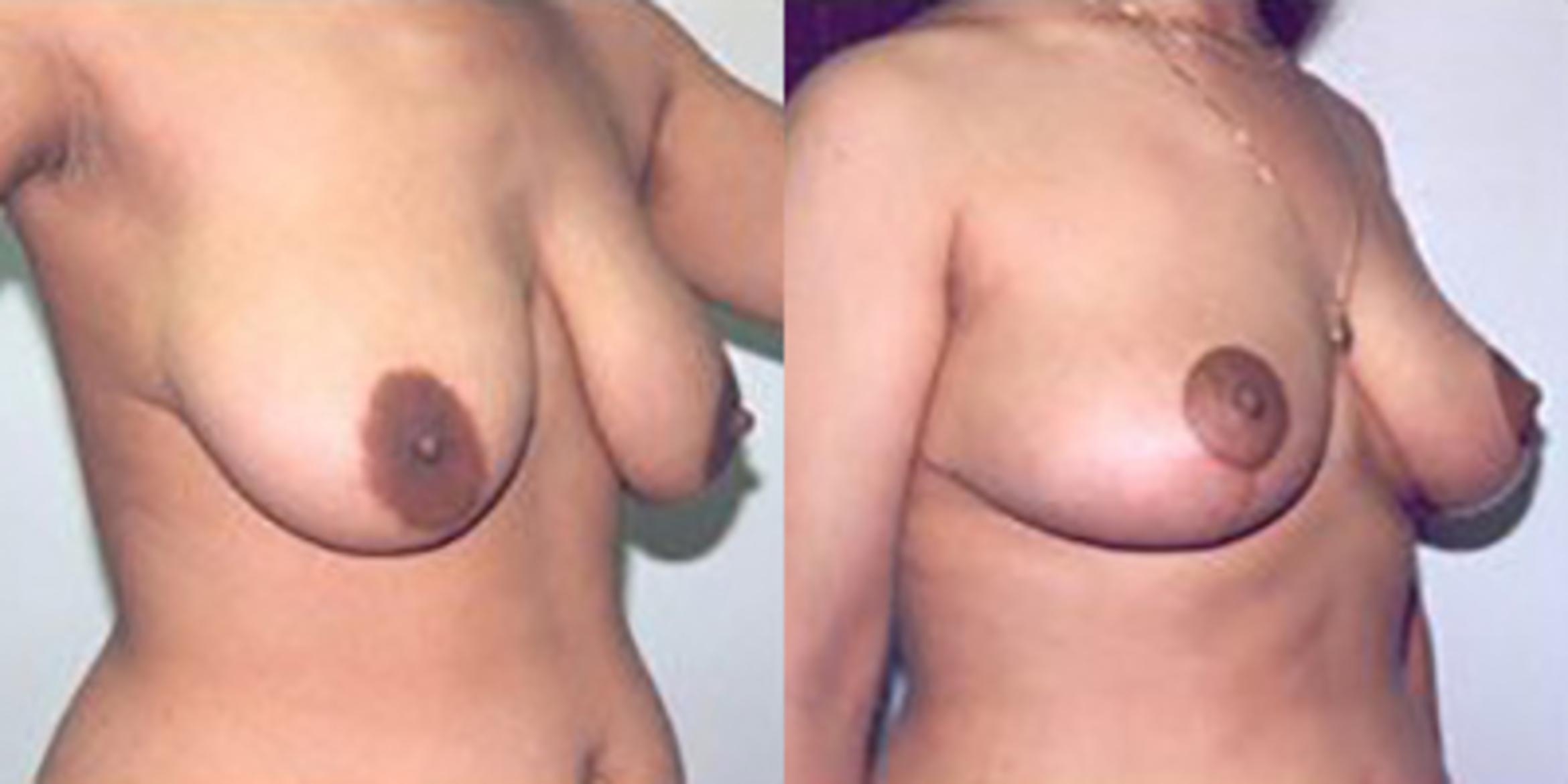 Before & After Breast Lift Case 4962 View 1 View in Houston, TX