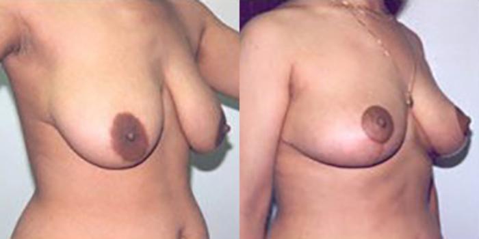 Before & After Breast Lift Case 4962 View 1 View in Houston, TX