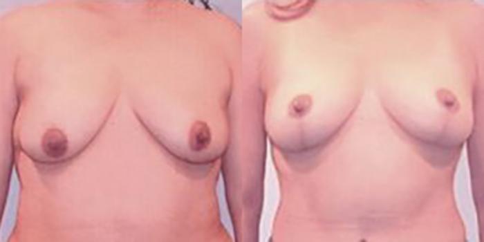 Before & After Breast Lift Case 4966 View 1 View in Houston, TX