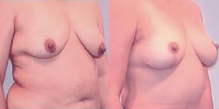 Before & After Breast Lift Case 4966 View 2 View in Houston, TX