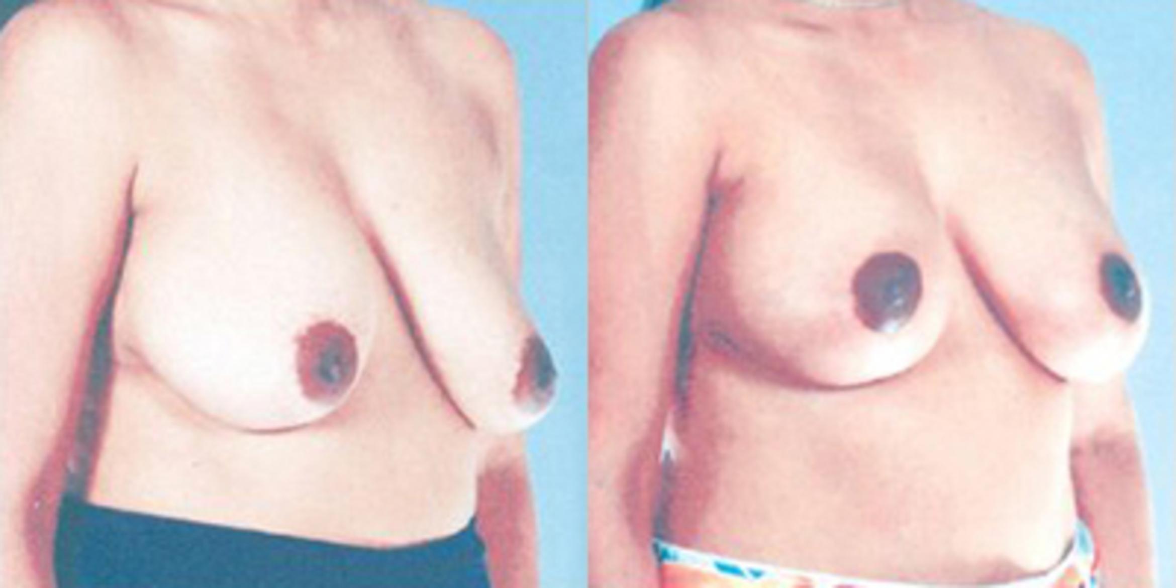 Before & After Breast Lift Case 4972 View 2 View in Houston, TX