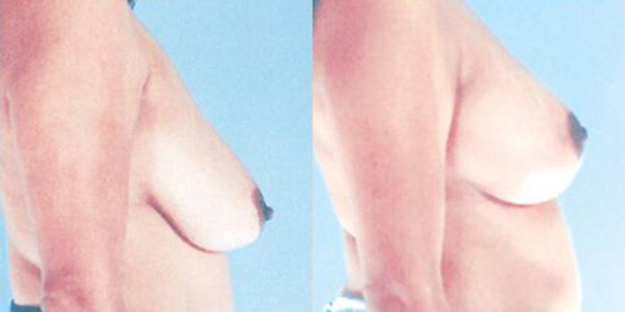 Before & After Breast Lift Case 4972 View 3 View in Houston, TX