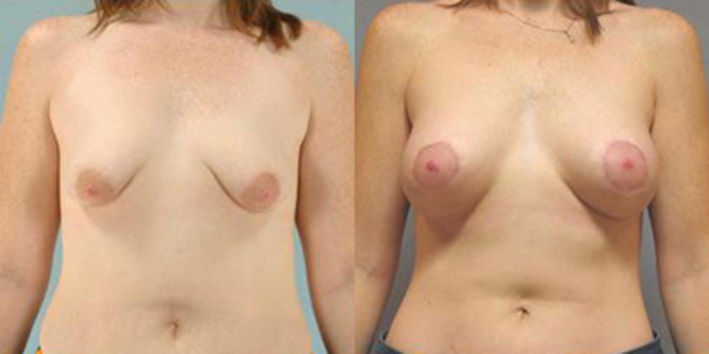 Before & After Breast Lift Case 4980 View 1 View in Houston, TX