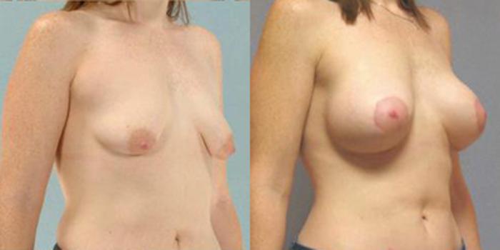 Before & After Breast Lift Case 4980 View 2 View in Houston, TX