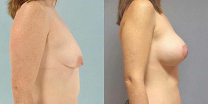 Before & After Breast Lift Case 4980 View 3 View in Houston, TX