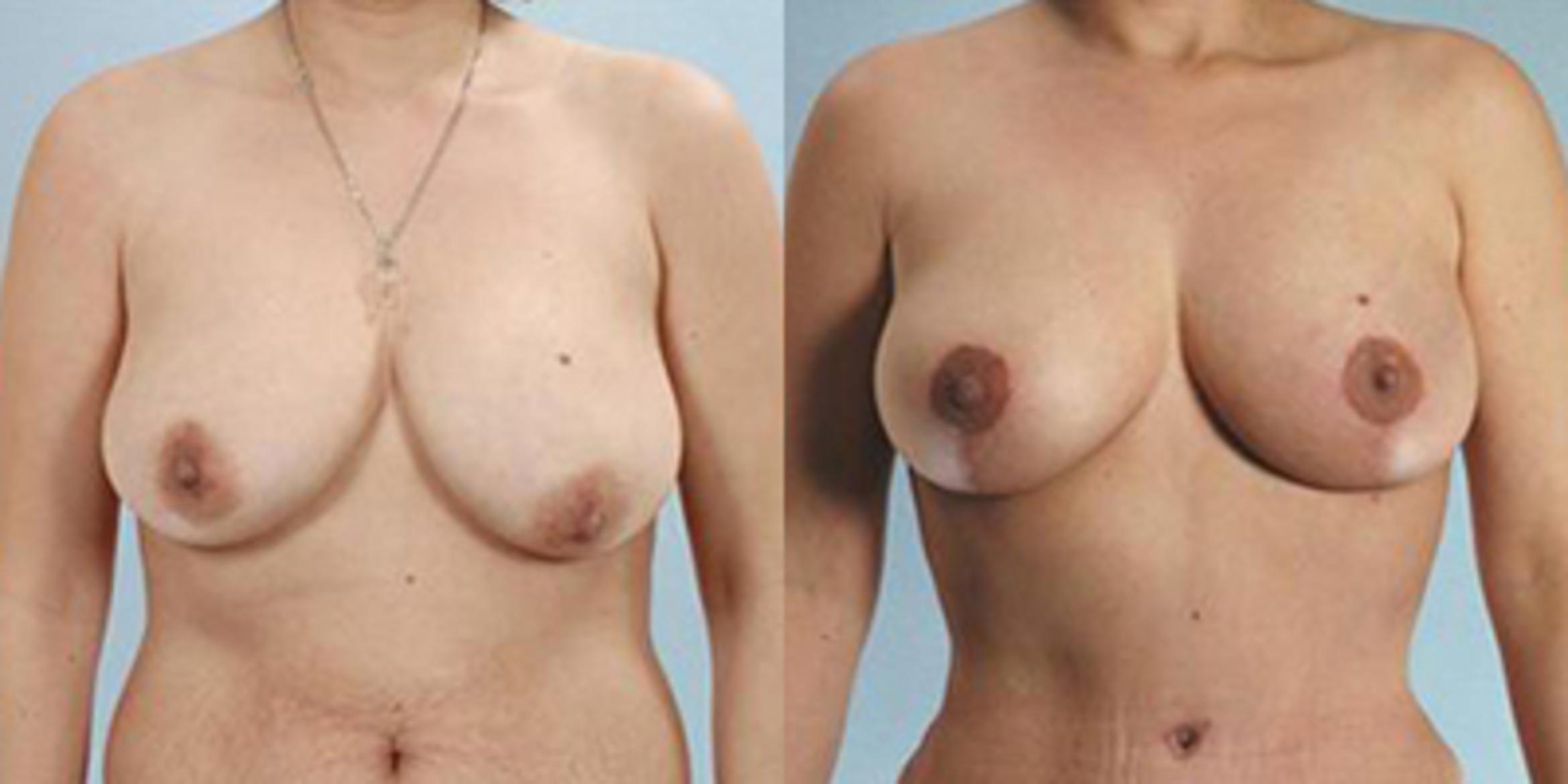 Before & After Breast Lift Case 4988 View 1 View in Houston, TX