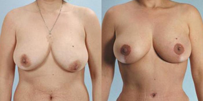 Before & After Breast Lift Case 4988 View 1 View in Houston, TX