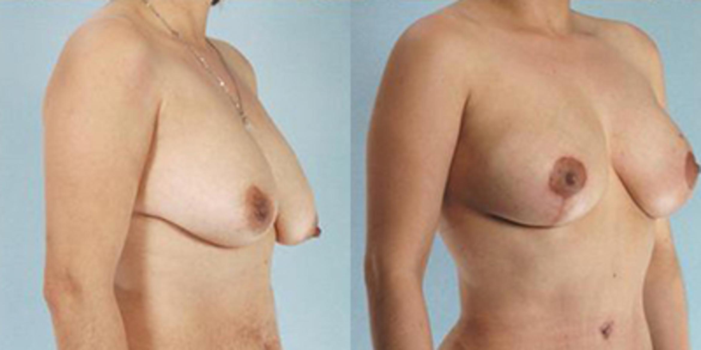 Before & After Breast Lift Case 4988 View 2 View in Houston, TX