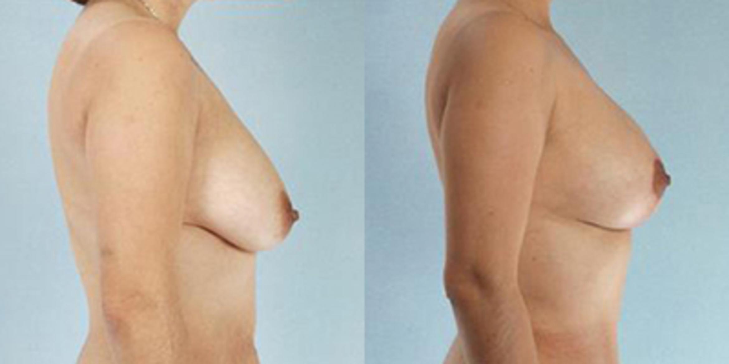 Before & After Breast Lift Case 4988 View 3 View in Houston, TX